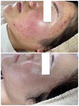 プリエ(Prier)/爆弾透明感！ハーブピーリング