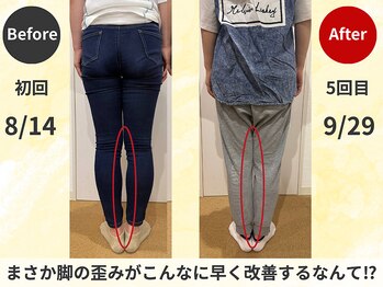 スロース鍼灸整体院(SLOTH鍼灸整体院)/О脚の改善例