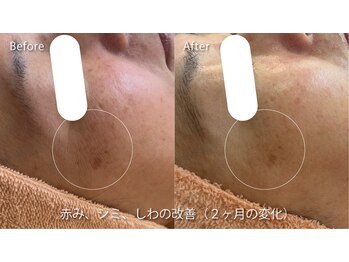 ミュー 春日井店(mieux)/◆肌質改善例