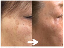 Private salon one-shotの雰囲気（しみにお悩みの方も大満足♪）