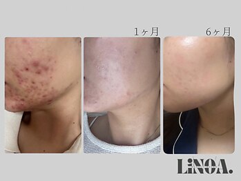 リノアドット(LiNOA.)/肌質改善サロンケア×スキンケア