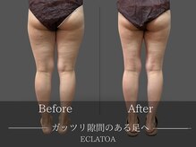 【次世代脂肪冷却・小顔ハイリフト専門店】ECLATOA　四日市/痩身/ダイエットの雰囲気（【脂肪冷却】自力では難しいサイズダウンもお任せください★）