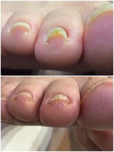 モアクリスタル(More Crystal)/巻き爪補正