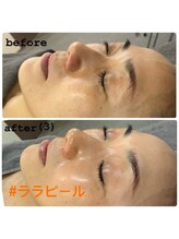 ビオトナス(Facial Esthe)/第4世代ララピールで水光肌♪