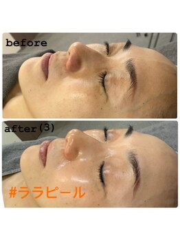 ビオトナス(Facial Esthe)/第4世代ララピールで水光肌♪