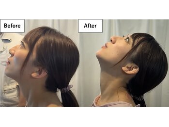 ブレア 銀座/BeforeAfter【鍼灸/カッピング】