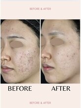 ラグラン銀座メディカルエステ 高輪ゲートウェイ店/大人のニキビケアお困りの方へ