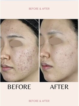 ラグラン銀座メディカルエステ 高輪ゲートウェイ店/大人のニキビケアお困りの方へ