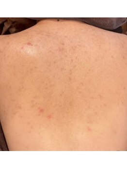 リベル 名古屋(Lebelle:)/ハーブピーリング専門 名古屋