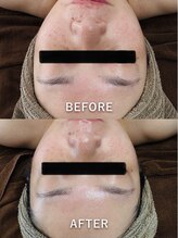 ルーク(Luke)/ニキビケア