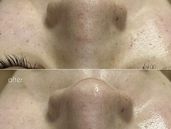 バタフライ 津田沼店(Butterfly)/毛穴洗浄《ハイドロスプラッシュ