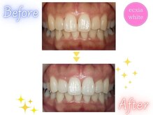 エクシアホワイトニング 八王子店/ホワイトニングビフォーアフター