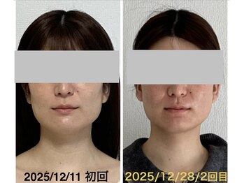 時空箱(ときのはこ)/四角いお顔をスッキリさせたい