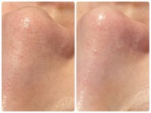 トータルビューティ ノイド(Noid)/毛穴洗浄　小鼻のみ