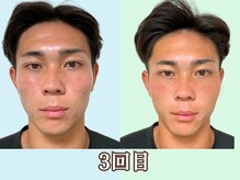 ナチュラルパーフェクトフェイス 新宿/メンズ新宿駅小顔矯正/渋谷区