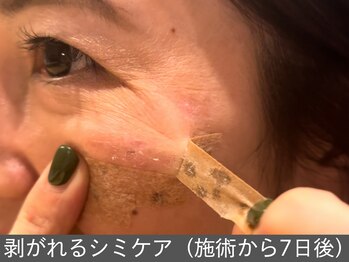 オアシスラグーン(OASIS LAGOON)/剥がれる!!シミのポイントケア