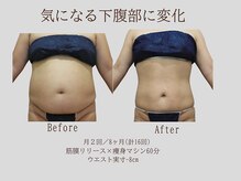 プレリー 自由が丘店/気になる下腹部に変化