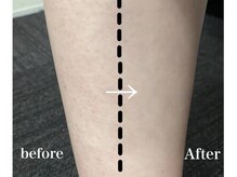 ハダハダ(HADA HADA Medical Esthetic)/毛穴のBefore→After★