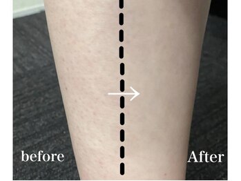 ハダハダ(HADA HADA Medical Esthetic)/毛穴のBefore→After★