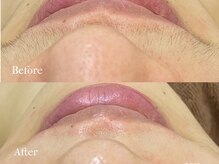 プレジール(plaisir)/産毛/角質/毛穴ケア