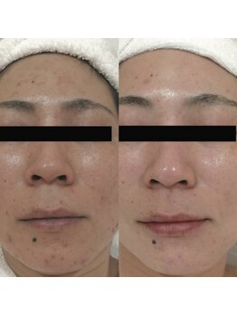 ホワイトアクア 梅田本店(WHITE AQUA)/ララピール/大阪/梅田/毛穴/小顔