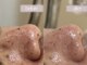 ミモザ(MIMOSA)の写真/【毛穴黒ずみ改善】毛穴レスの美肌へ！根本改善できるREVI陶肌ハーブピーリング♪剥離・ダウンタイム無し★