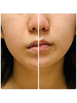 レモンローズ(Lemon Rose)/高周波小顔フェイシャル