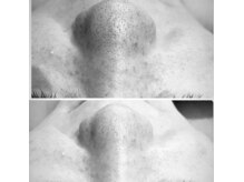 くつろぎ処癒家/毛穴洗浄　