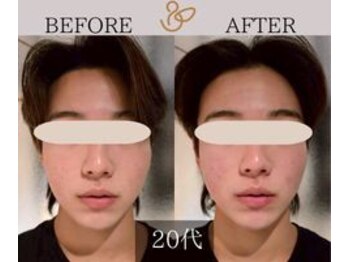 チョコバリ 新宿店(chocobari)/小顔×リフトアップ(美容鍼)20代