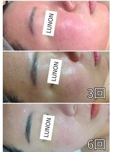 ルノン(LUNON)/赤みBefore/After