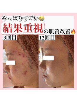 アルムダアクア 天王寺店(Aleumda AQUA)/ハーブピーリング/大阪/天王寺