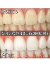 シカホワイトニングトウキョウ 笹塚店(CICA Whitening Tokyo)/ビフォーアフター（20代女性）