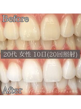 シカホワイトニングトウキョウ 笹塚店(CICA Whitening Tokyo)/ビフォーアフター(20代女性)