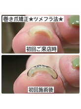 マニュコクーン(ManuCocoon)/爪育成　深爪　巻き爪　大阪市