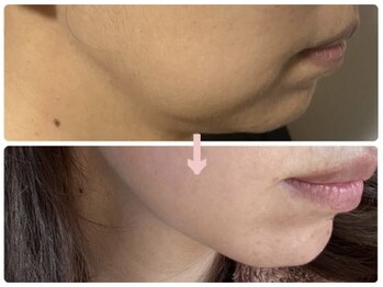 ディオ(Dio)/たるみ改善・小顔ケア