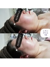 RiとBiのたまご/（フェイシャル）レモンボトル