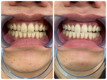 コナホワイトニング 神保町/セルフホワイトニング神保町