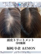 アンドエモン(&EMON)/【頭皮】プロセル効果