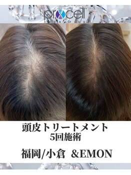 アンドエモン(&EMON)/【頭皮】プロセル効果