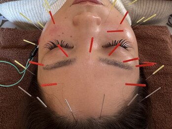 キュライム(CURAIM)の写真/たるみ・むくみを劇的改善！美容鍼灸で深層筋を引き上げ、引き締まったシャープなフェイスラインへ★