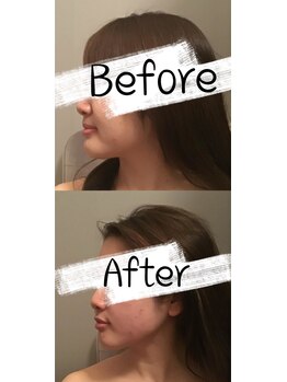 ティアラボ(TIARABO)/立体小顔