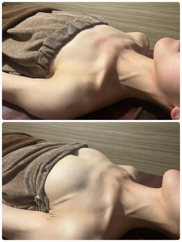 ライズサロン(RiseSALON)/【魅惑のバストアップ】症例