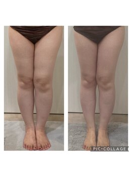 クリスタル(CRYSTAL)/【セル脂肪撃退】下半身コース