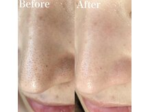 チュチュ(TUTU)/毛穴洗浄