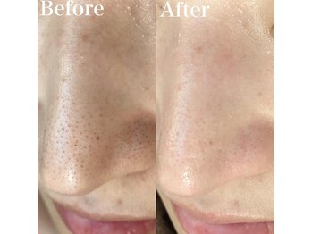 チュチュ(TUTU)/毛穴洗浄