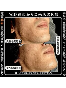 ディースタイル 北谷店(Dstyle)/北谷メンズ脱毛ヒゲBefore after