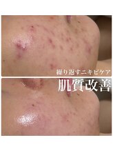 メロー(MELLOW)/繰り返すニキビ・赤み