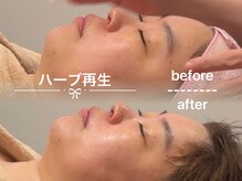 ソワン ド ブランシュ ライフ八戸ノ里店(Soin de Blanche)/ゆらぎ肌の赤み鎮静ケア