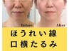 【シワたるみスペシャル】全顔シワたるみ集中×小顔整体80分☆通常22000