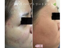 リンパサロンナチュレール (naturel)の雰囲気（人気！REVIハーブピーリング ！！艶々光るお肌に♪）